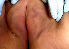 labia saline infusion